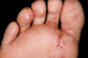 Blog foot